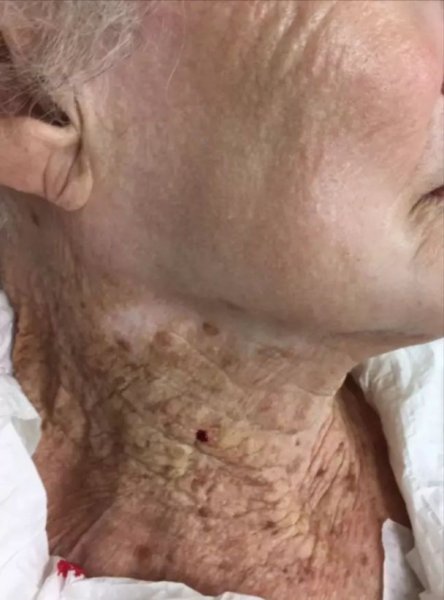
Женщина, которая 40 лет носила солнцезащитный крем только на лице, шокировала видом шеи - фото
