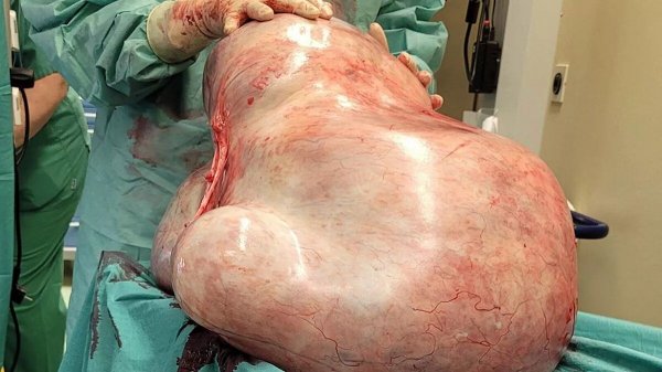 
Жаловалась на одышку: 24-летней женщине удалили необычную опухоль весом 32 кг – фото
