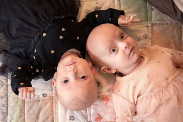 
Сиамских близнецов разъединили во время рискованной 4-часовой операции: фото, подробности
