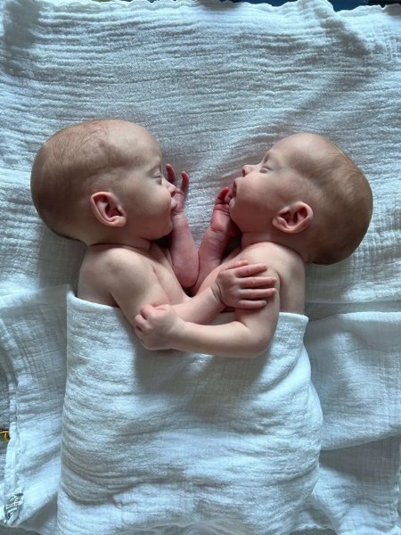
Сиамских близнецов разъединили во время рискованной 4-часовой операции: фото, подробности
