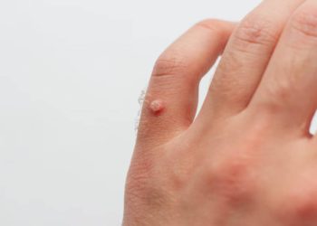 Sen o brodawkach może mieć niespodziewane znaczenie. Sprawdź, co oznaczają brodawki pojawiające się na różnych częściach ciała według ludowych i współczesnych senników.